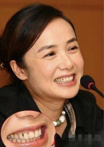 明星长蛀牙,口腔健康不容忽视
